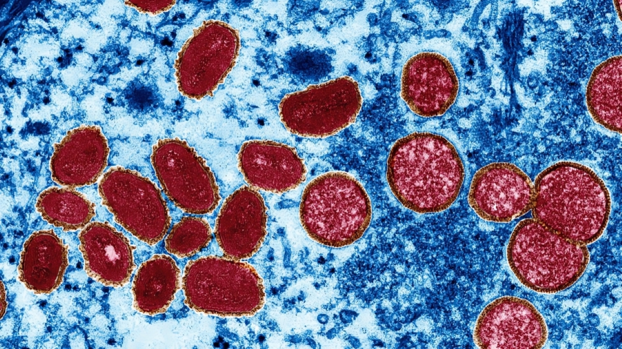 Turkish National Cleared of Monkeypox Suspicion in Dhaka