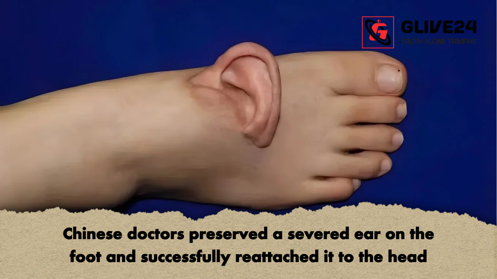 Chinese doctors preserved a severed ear on the foot and successfully reattached it to the head 1 Chinese doctors preserved a severed ear on the foot and successfully reattached it to the head Chinese doctors preserved a severed ear on the foot and successfully reattached it to the head