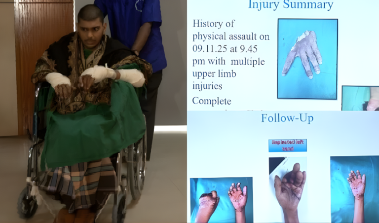 Severed Hands Reattached After 20 Hours in Historic Surgery Severed Hands Reattached After 20 Hours in Historic Surgery