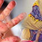 Measles Outbreak Escalates In Cumilla As Infant Dies Measles Outbreak Escalates In Cumilla As Infant Dies
