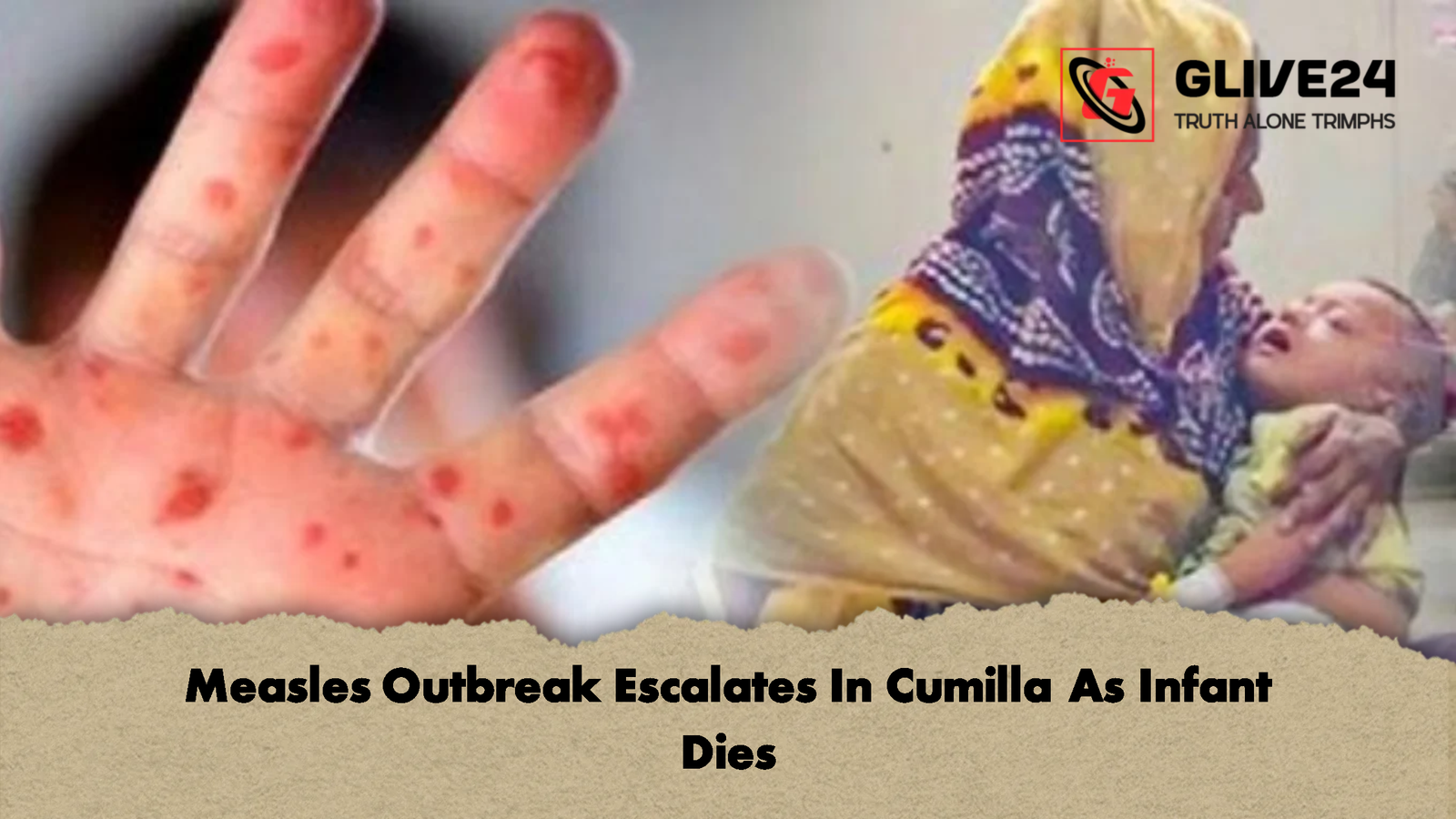 Measles Outbreak Escalates In Cumilla As Infant Dies 2 Measles Outbreak Escalates In Cumilla As Infant Dies