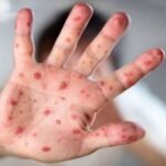 Seven Children Die from Measles and Related Symptoms Seven Child Measles Fatalities