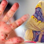 ২৪ ঘণ্টায় হামের উপসর্গে সাতজন শিশুর মৃত্যু Measles outbreak claims seven children in Bangladesh update