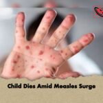 Child Dies Amid Measles Surge 1 Child Dies Amid Measles Surge