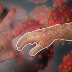 Measles Complications Claim More Lives In Bangladesh Hospital Measles Complications Claim More Lives In Bangladesh Hospital