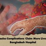 Measles Complications Claim More Lives In Bangladesh Hospital 2 Measles Complications Claim More Lives In Bangladesh Hospital