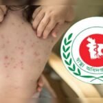 Measles Death Toll Reaches 499 1 Measles Death Toll Reaches 499