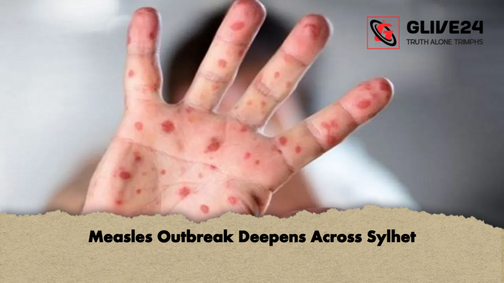 Measles Outbreak Deepens Across Sylhet 1 Measles Outbreak Deepens Across Sylhet Measles Outbreak Deepens Across Sylhet