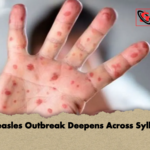 Measles Outbreak Deepens Across Sylhet Measles Outbreak Deepens Across Sylhet