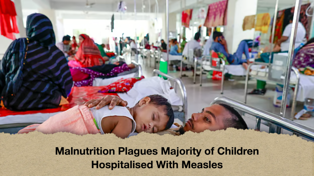 Malnutrition Plagues Majority of Children Hospitalised With Measles Malnutrition Plagues Majority of Children Hospitalised With Measles