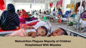 Malnutrition Plagues Majority of Children Hospitalised With Measles Malnutrition Plagues Majority of Children Hospitalised With Measles