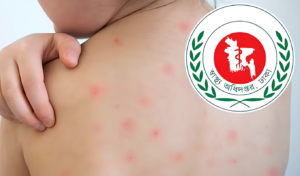 Measles Outbreak Claims Five More Lives as Toll Reaches 885 Measles Outbreak Claims Five More Lives as Toll Reaches 885