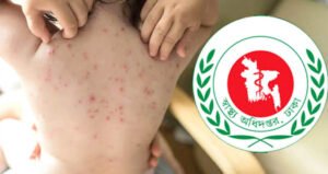 Three Children Die as Measles Outbreak Continues Across Bangladesh