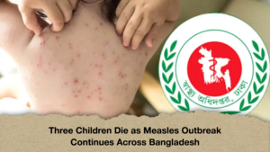 Three Children Die as Measles Outbreak Continues Across Bangladesh Three Children Die as Measles Outbreak Continues Across Bangladesh