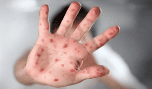 Another Child Dies of Measles at Mymensingh Medical College Hospital