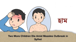 Two More Children Die Amid Measles Outbreak in Sylhet